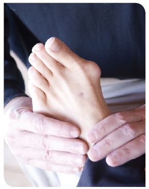 bunions