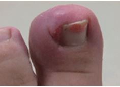 ingrown nails